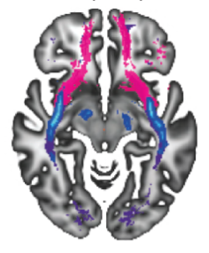 Utsnitt av hjernen som viser nervebaner knyttet til høyere nivåer av 
psykiske symptomer hos barn og unge.