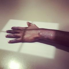 Røntgen av hånd er én av metodene som norske myndigheter har brukt for å fastslå alderen til ungdommer som søker asyl. Foto: Aisha Munir